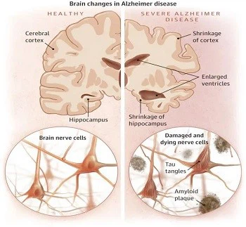 Pathological changes in the brain of Alzheimer's disease patients Pathological changes in the brain of Alzheimer's disease patients