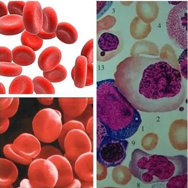 Long term use of Pyrimethamine can interfere with folate utilization in the body, leading to megaloblastic anemia Long term use of Pyrimethamine can interfere with folate utilization in the body, leading to megaloblastic anemia