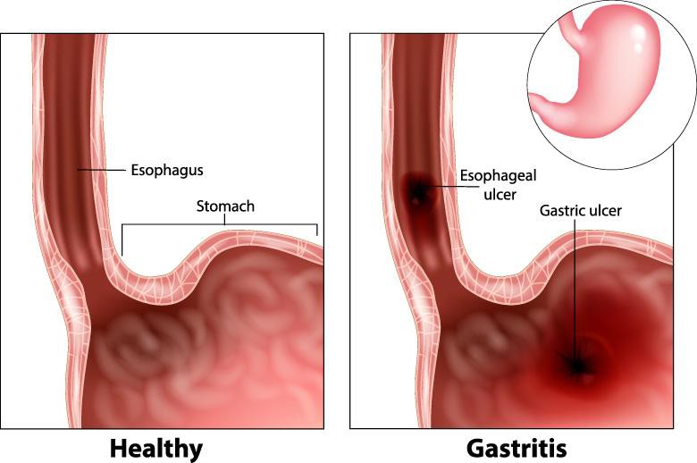 Gastritis and gastric ulcer Gastritis and gastric ulcer