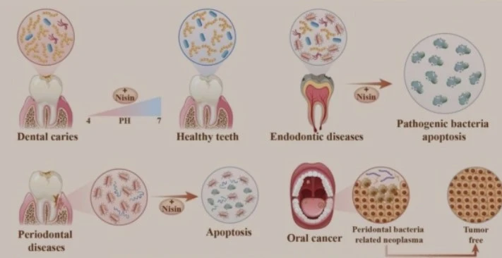 Nisin and its application in oral diseases Nisin and its application in oral diseases